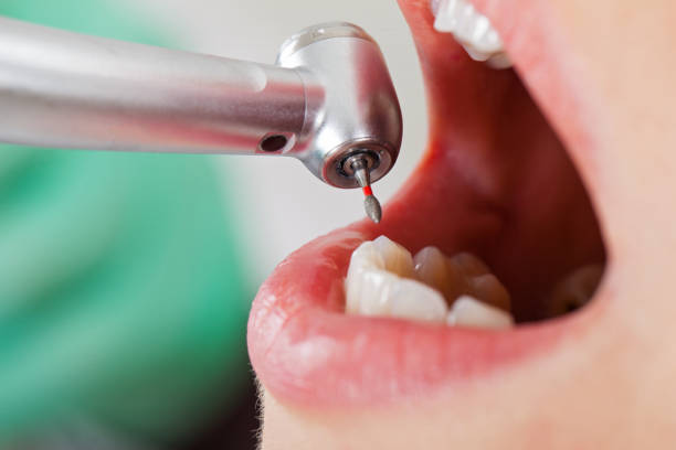 Best Broken or Cracked Tooth Emergency Dentist in Shelburne Falls, MA